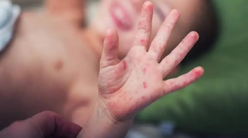 Балада Кавасаки синдромы барын қалай анықтауға болады