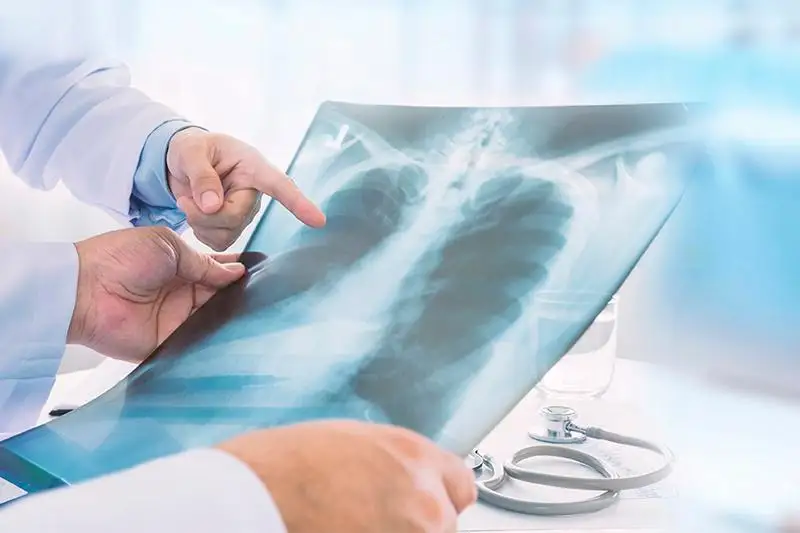 Пневмония: Тағы 5 өлім жағдайы тіркелді