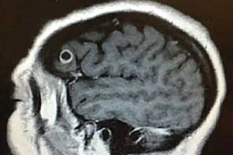 АҚШ-та адам миы құрттап кеткен