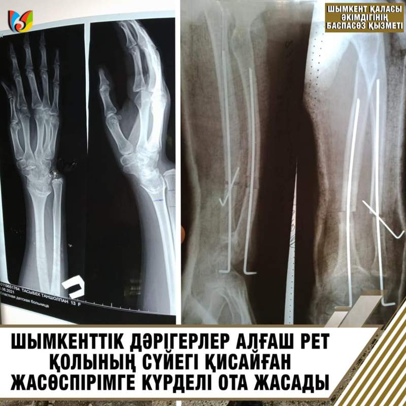 Шымкенттік дәрігерлер қисайған сүйекке алғаш рет ота жасады