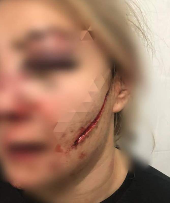 Талғарда жас қыздың бетін бұрынғы жігіті тілгілеп тастаған