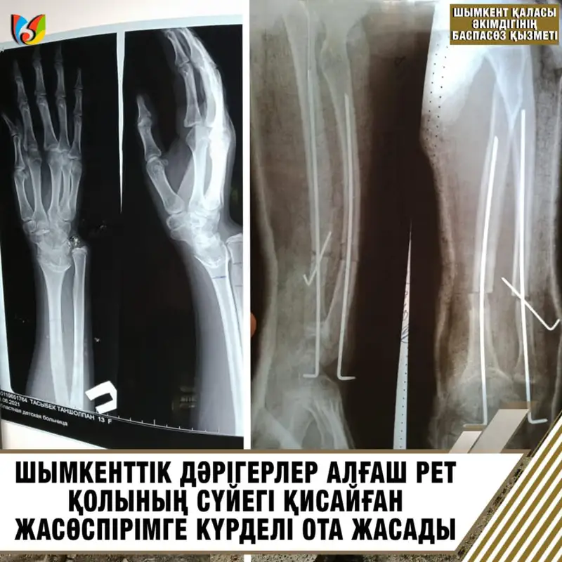 Шымкенттік дәрігерлер қисайған сүйекке алғаш рет ота жасады