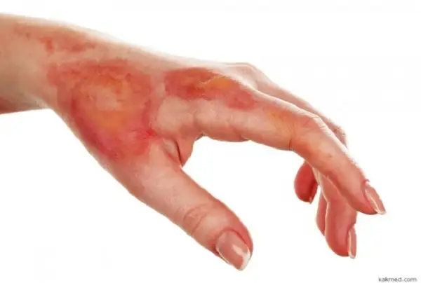 Отандық ғалымдар күйікті емдеудің жаңа тәсілін ойлап тапты