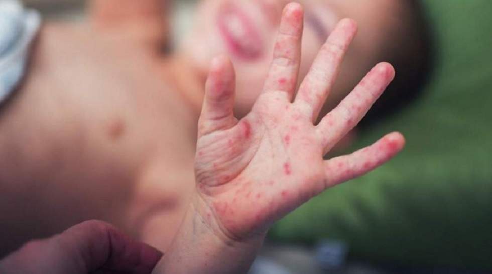 Балада Кавасаки синдромы барын қалай анықтауға болады